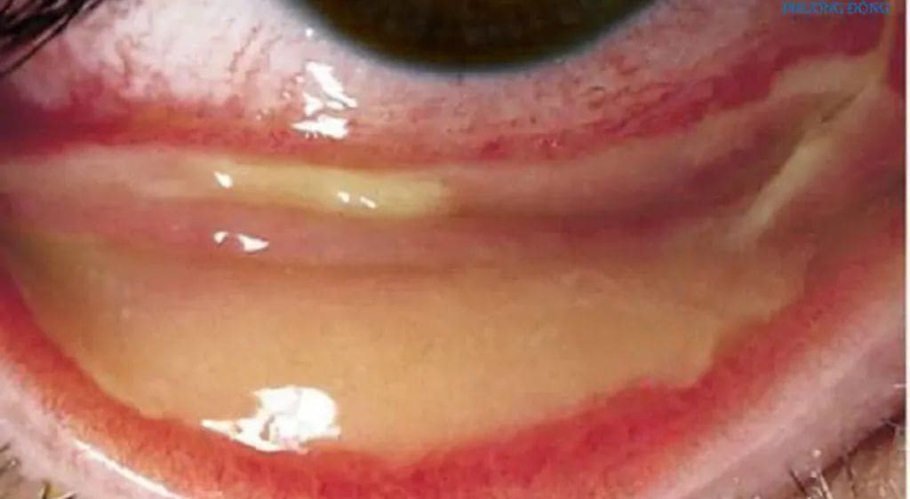 Viêm kết mạc có giả mạc cảnh báo tình trạng viêm nhiễm nghiêm trọng