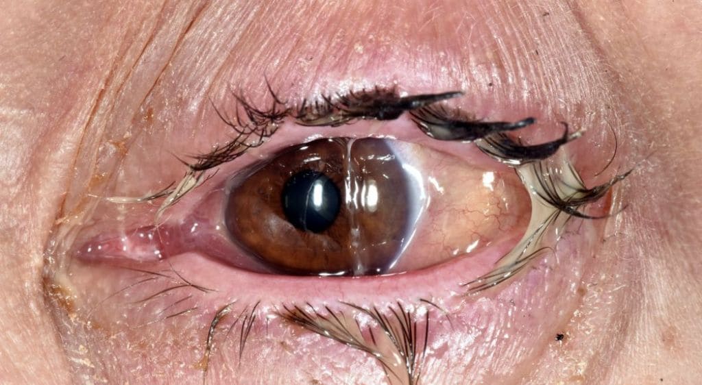 Viêm kết mạc là tình trạng viêm lớp màng trong suốt bao phủ lòng trắng