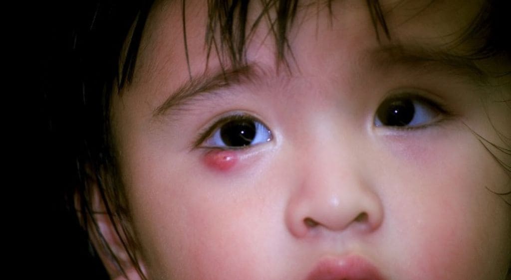 Viêm mí mắt nếu không điều trị kịp thời có thể dẫn đến biến chứng lẹo và chắp ở trẻ