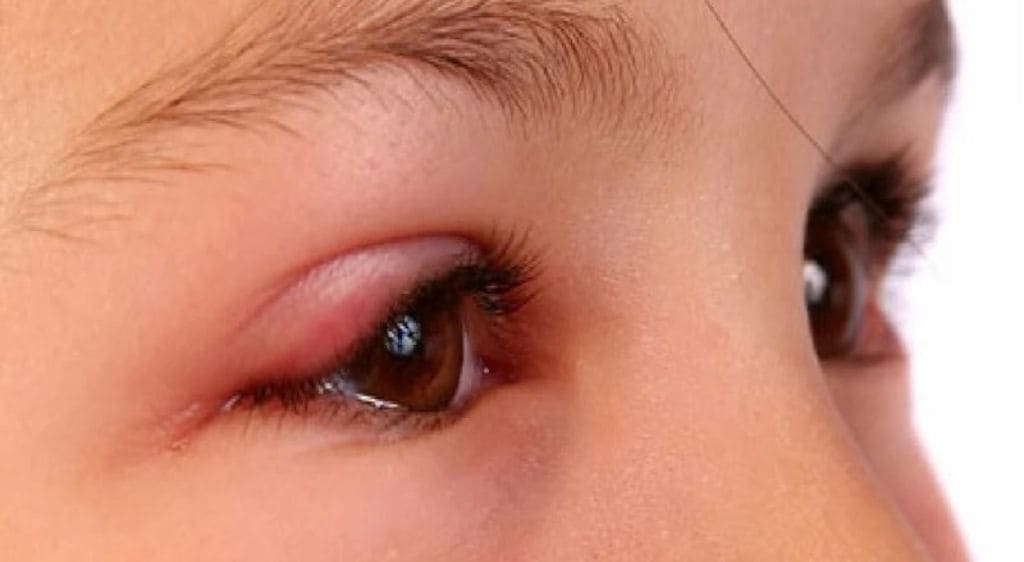 Viêm mí mắt ở trẻ em