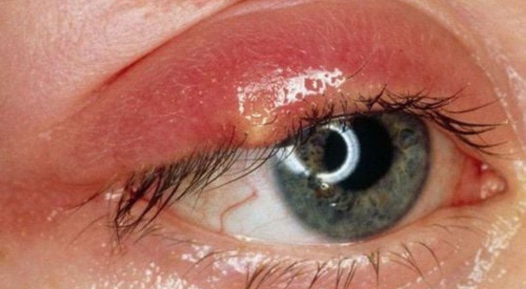 Viêm mí mắt trên là tình trạng viêm biểu hiện ở phần rìa tự do của mí mắt trên