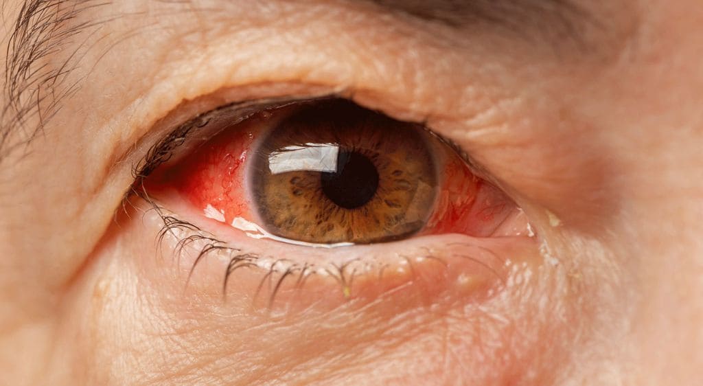 Viêm mống mắt nếu không được điều trị sớm có thể dẫn đến biến chứng glocom