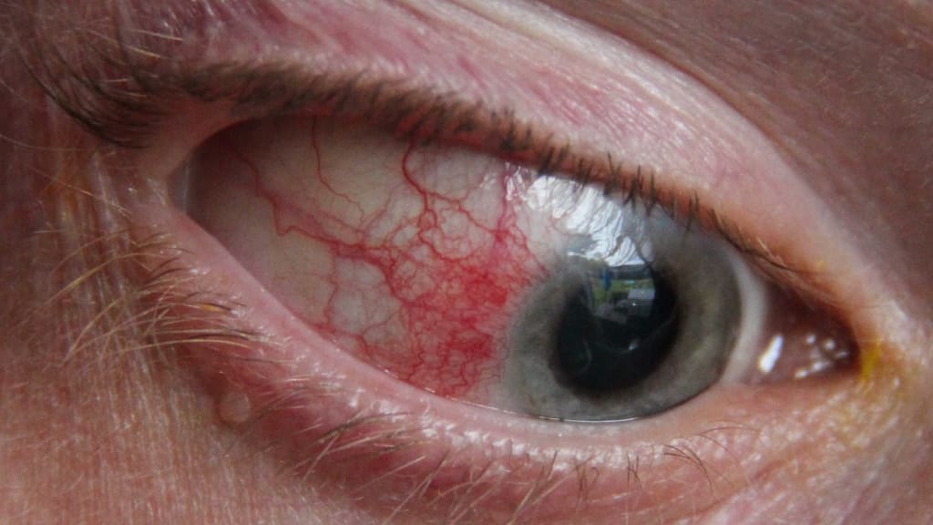 Viêm thượng củng mạc đơn thuần phổ biến hơn và có thể khỏi mà không cần điều trị