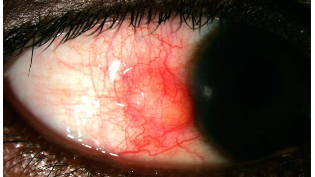 Viêm thượng củng mạc nốt thường hiếm gặp hơn