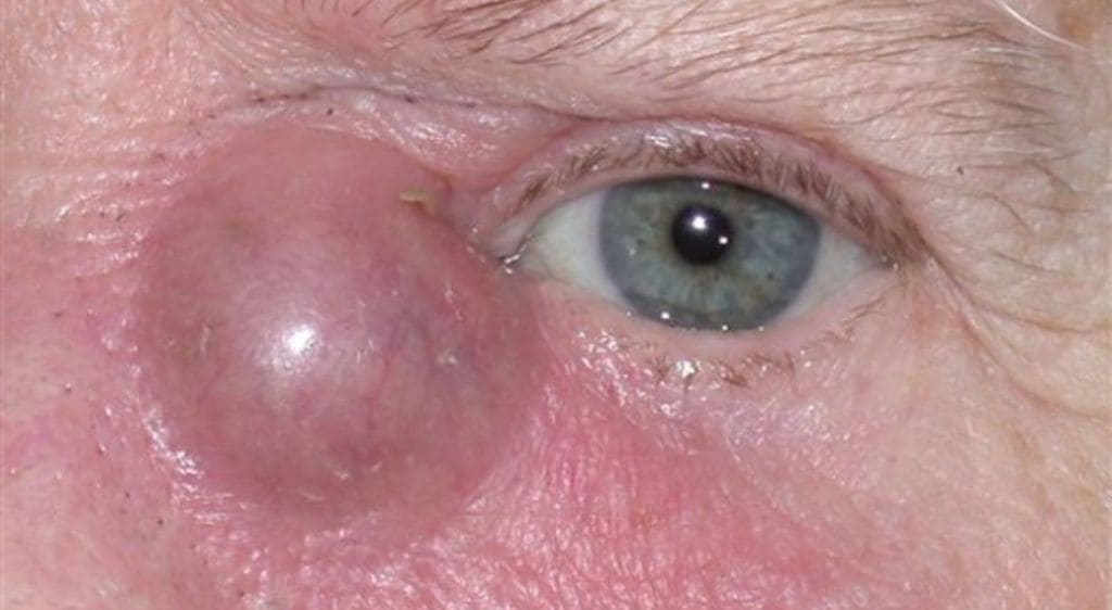 Viêm túi lệ xảy ra khi nước mắt bị tắc nghẽn, dẫn đến nhiễm khuẩn và gây viêm