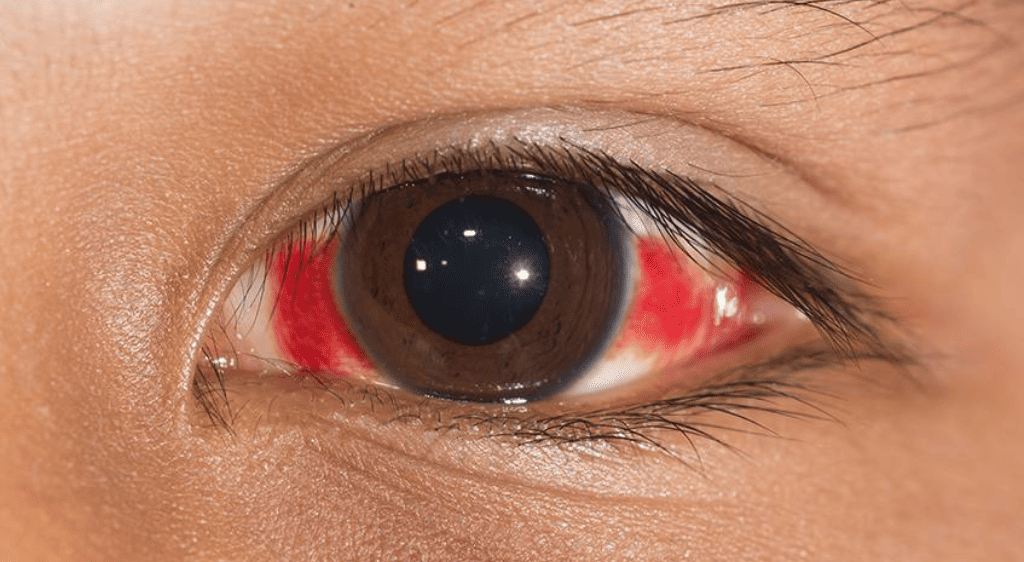 Xuất huyết dịch kính sau khi bị sốt xuất huyết rất nguy hiểm