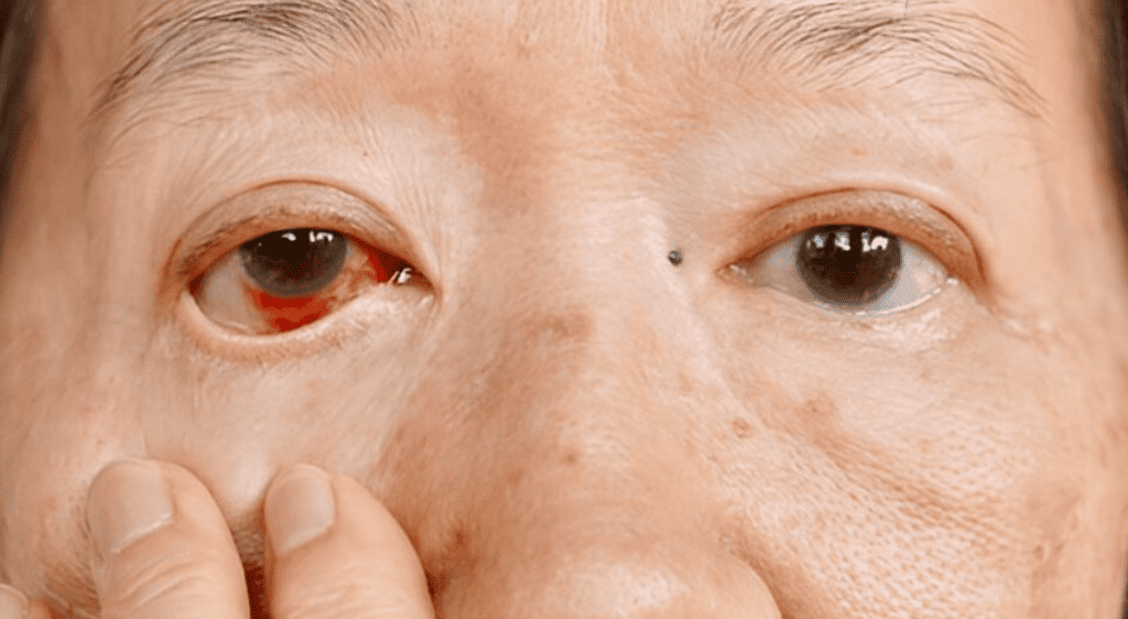 Xuất huyết kết mạc hoàn toàn không lây nhiễm vì không liên quan đến virus, vi khuẩn