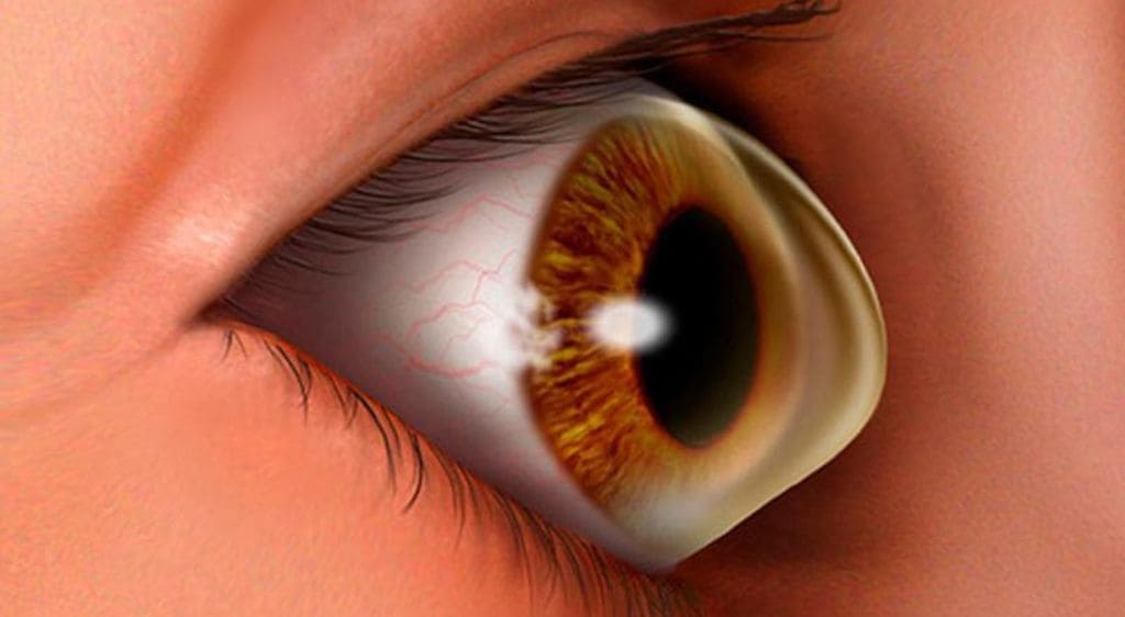 Bệnh giác mạc hình chóp là tình trạng cấu trúc giác mạc chóp bị thay đổi