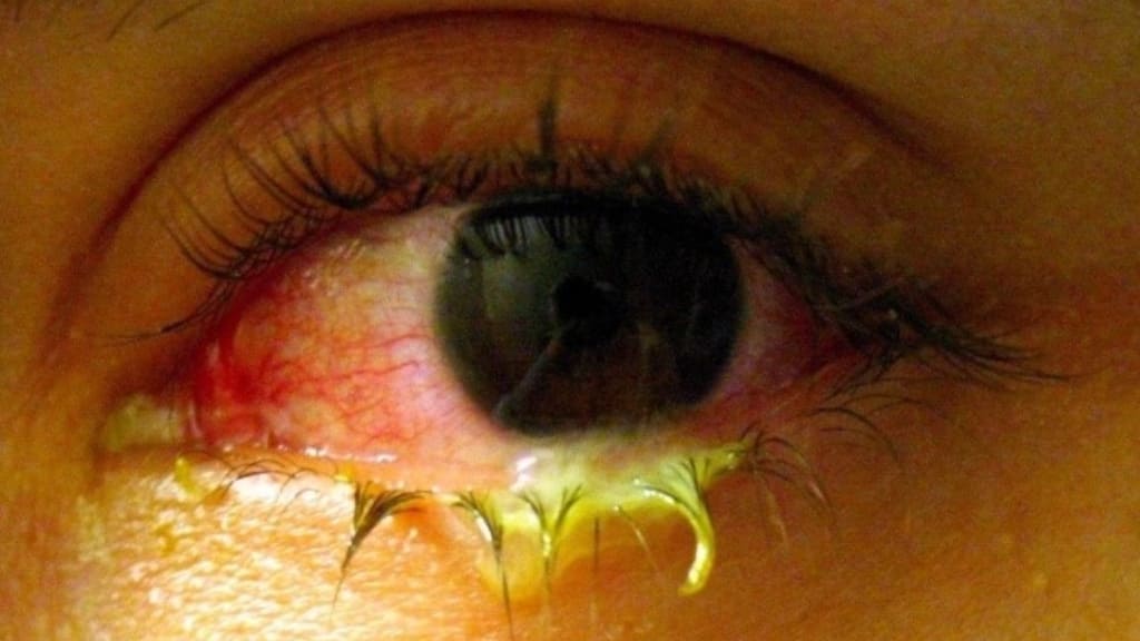 Bệnh nhân cần đi tái khám ngay lập tức nếu mắt chảy dịch nhiều, không kiểm soát