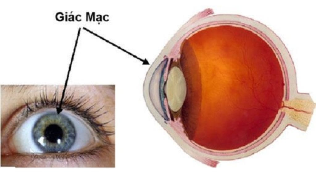 Bong giác mạc là tình trạng lớp tế bào ngoài cùng của lòng đen bị bong tróc