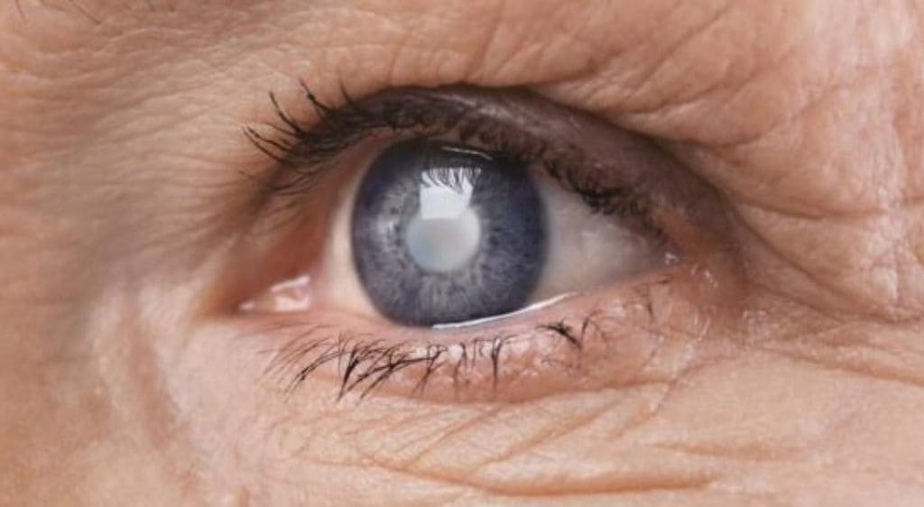 Chi phí ghép giác mạc nhân tạo đắt hơn ghép giác mạc thông thường