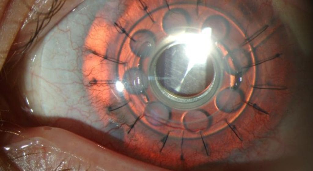 Chi phí thay giác mạc nhân tạo thường rất cao do nguyên liệu mắc tiền và kỹ thuật phức tạp