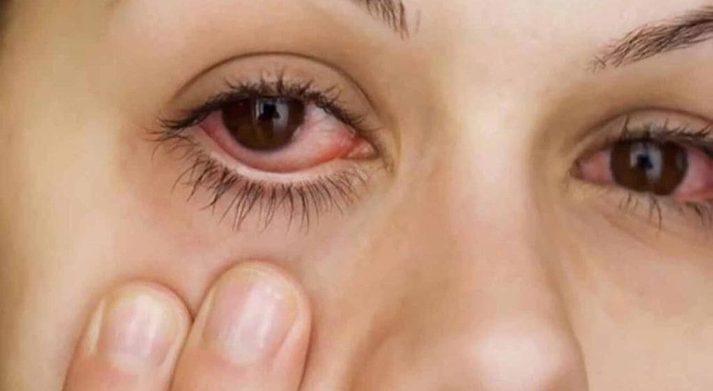 Dị vật giác mạc có thể gây xuất huyết kết mạc