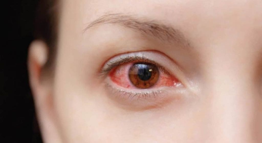 Dị vật giác mạc gây đau rát, cộm xốn và đỏ mắt