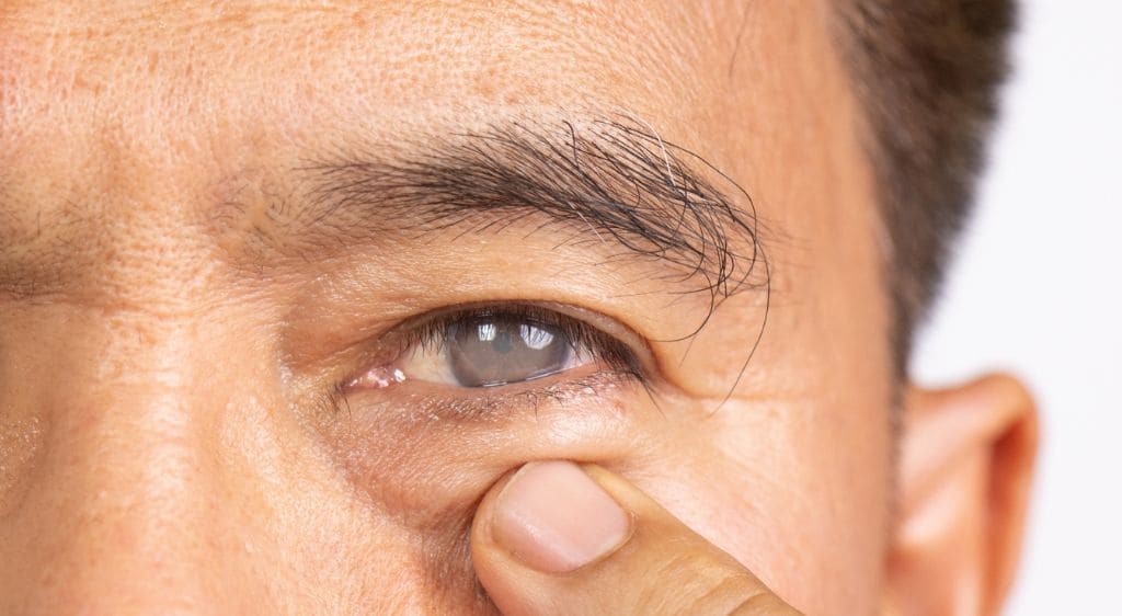 Đục giác mạc có thể gây mù lòa nếu không được can thiệp kịp thời