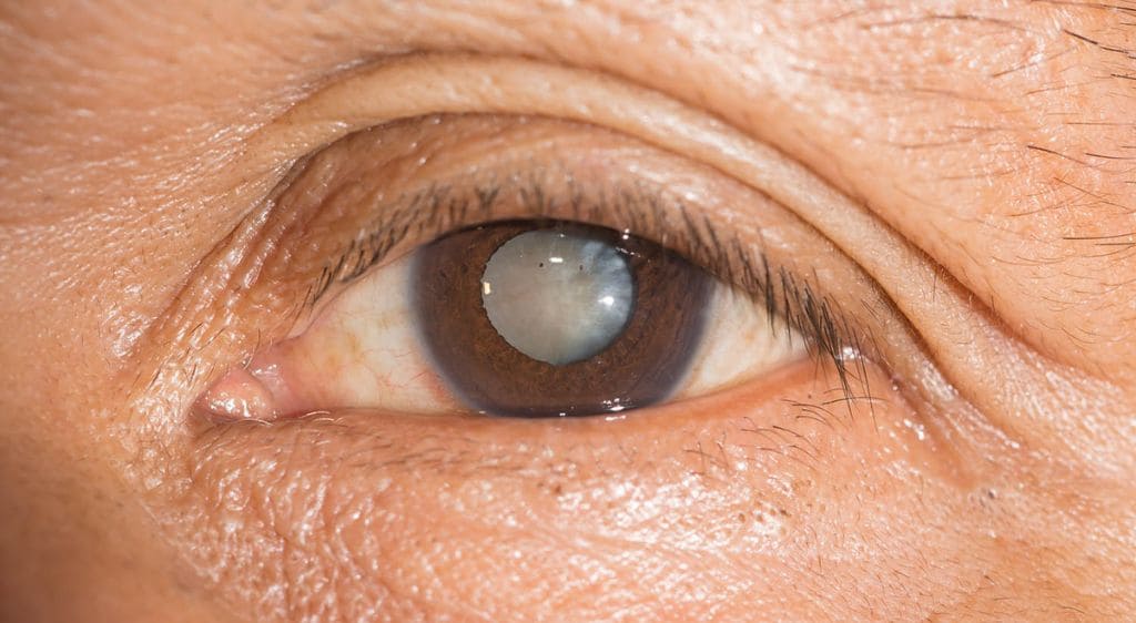 Đục giác mạc là tình trạng xuất hiện màng đục che phủ đồng tử