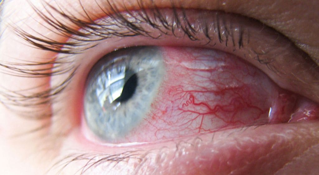 Giác mạc bị tổn thương do bỏng ảnh hưởng trực tiếp đến khả năng nhìn và cần xử trí sớm