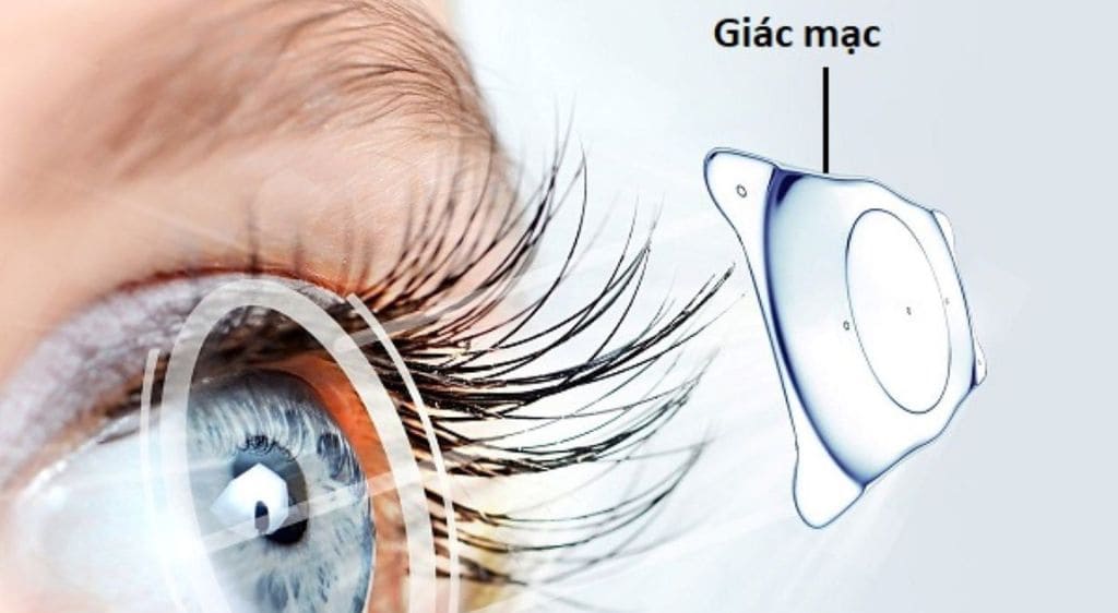 Giác mạc nhân tạo là một thiết bị được chế tạo từ các vật liệu tổng hợp sinh học chất lượng cao