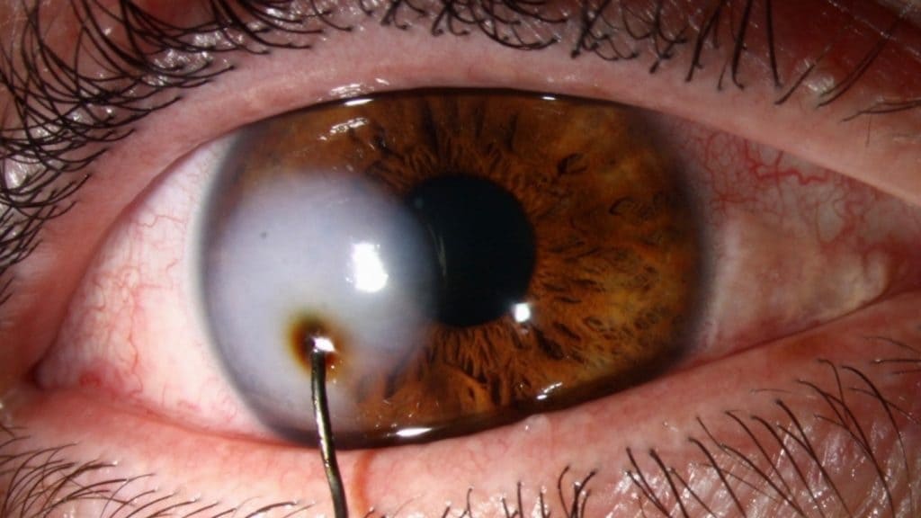 Khâu giác mạc được thực hiện để đóng kín các vết thương trên giác mạc