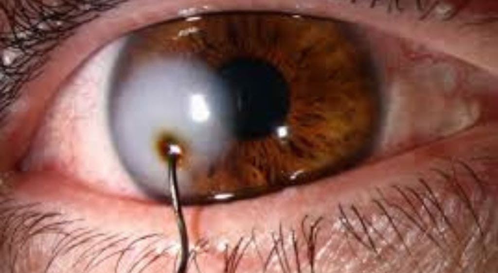 Khi bị tổn thương, cần phải lấy dị vật ra đúng cách để hạn chế tổn thương nghiêm trọng hơn