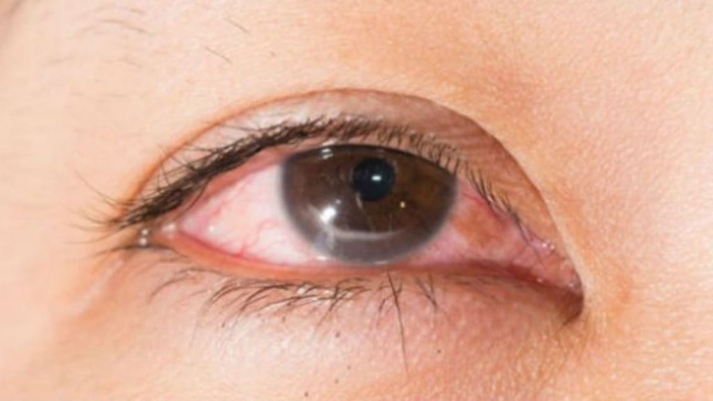 Khô giác mạc là tình trạng tổn thương trên bề mặt lòng đen mắt