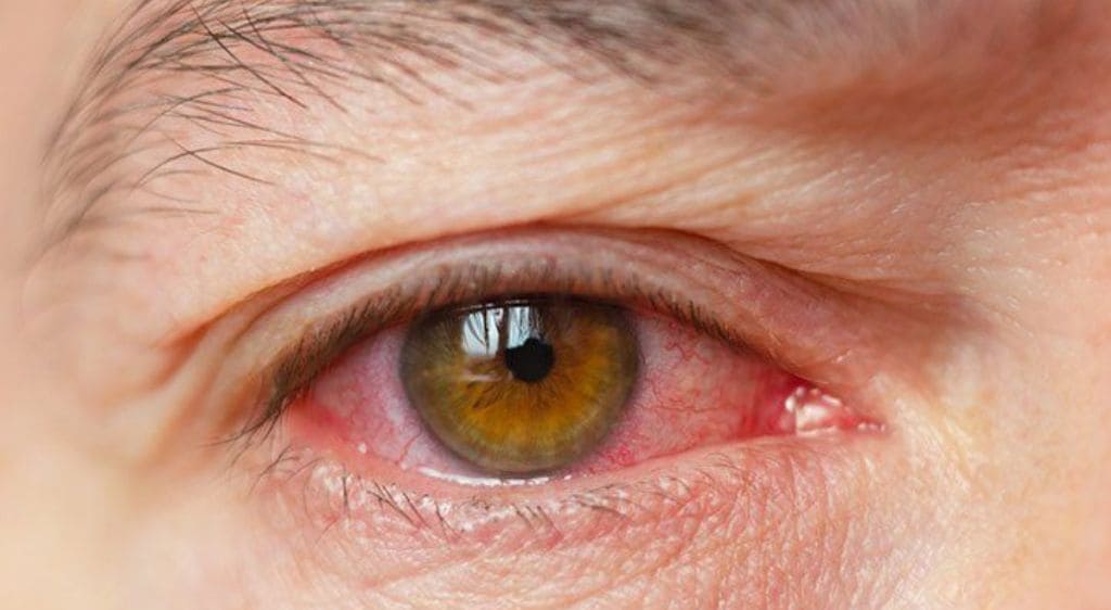 Khô mắt là nguyên nhân hàng đầu gây viêm giác mạc sợi