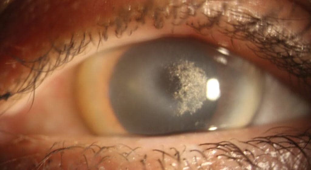 Loạn dưỡng giác mạc là tình trạng giác mạc bị lắng đọng một chất màu trắng đục