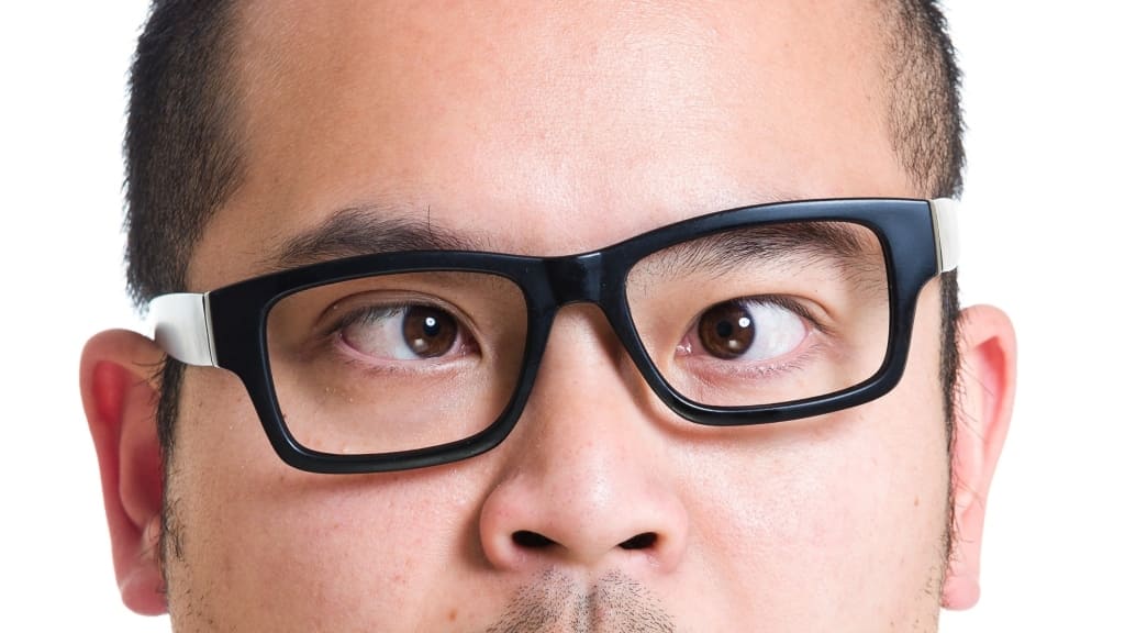 Mắt bị lác (lé) là một trong những nguyên nhân điển hình dẫn đến nhược thị ở trẻ