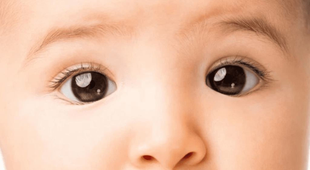 Mắt trẻ bị lác là dấu hiệu báo động đỏ cho thấy mắt đó đang bị nhược thị nặng