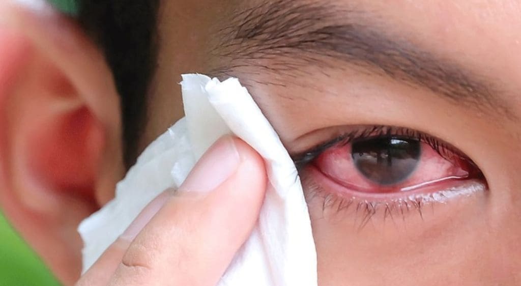 Nghi ngờ có dị vật trong mắt cần thực hiện siêu âm ngay để loại bỏ