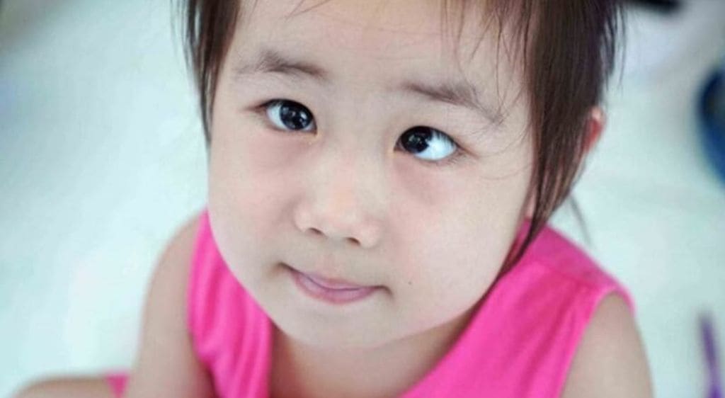 Nhược thị bẩm sinh là tình trạng suy giảm thị lực từ khi trẻ mới chào đời