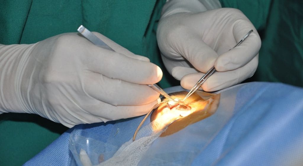 Phẫu thuật ghép giác mạc khi sẹo đã dày gây suy giảm thị lực