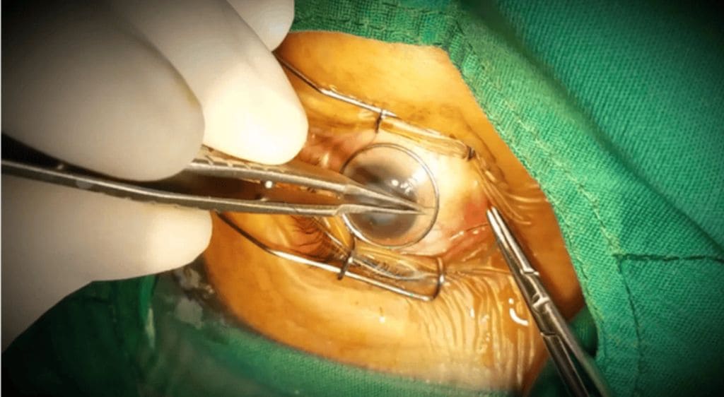 phẫu thuật ghép giác mạc