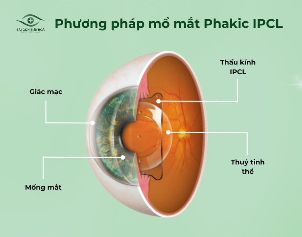 Phẫu thuật Phakic ICL/IPCL giúp chỉnh tật khúc xạ mức độ cao và cải thiện thị lực mà không cần can thiệp vào giác mạc