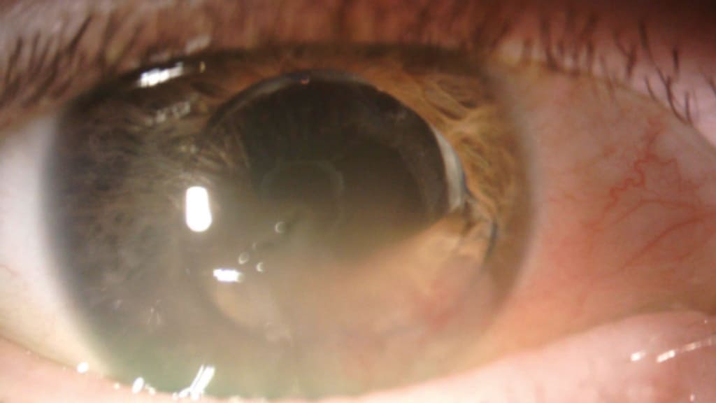 Phù giác mạc là tình trạng giác mạc tích tụ dịch, mất đi độ trong suốt do tổn thương