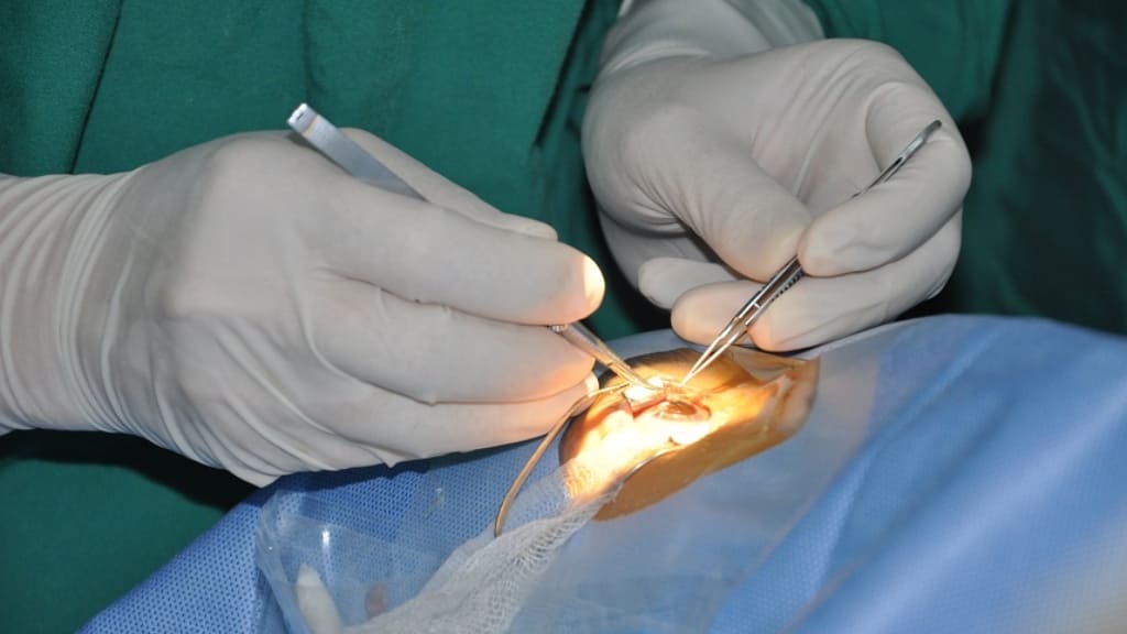 Quy trình phẫu thuật khâu giác mạc được thực hiện qua nhiều bước khác nhau