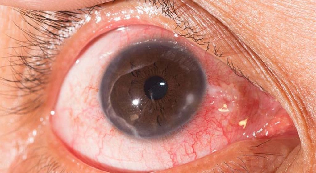 Rách giác mạc là cấp cứu nhãn khoa cực kỳ nguy hiểm cần được xử trí kịp thời