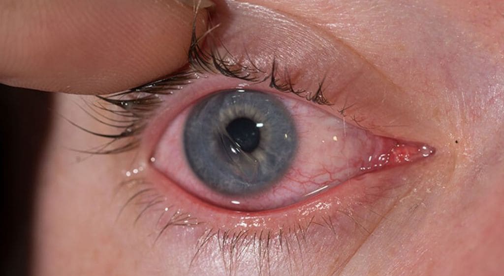 Rách giác mạc thường xảy ra do các tác động vật lý trực tiếp từ bên ngoài