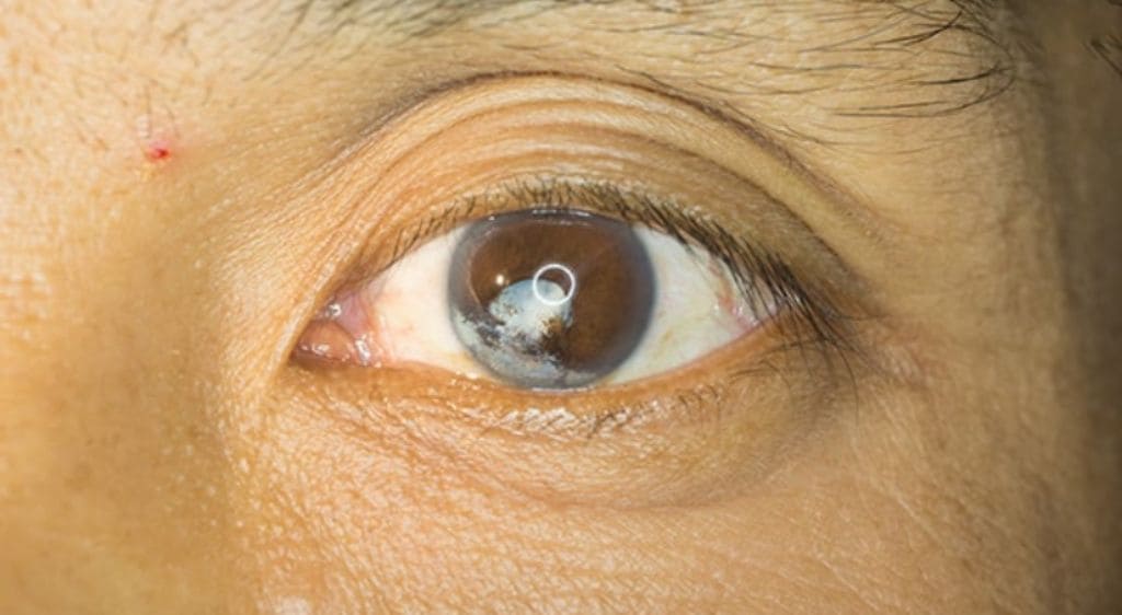 Sẹo giác mạc dày gây suy giảm thị lực