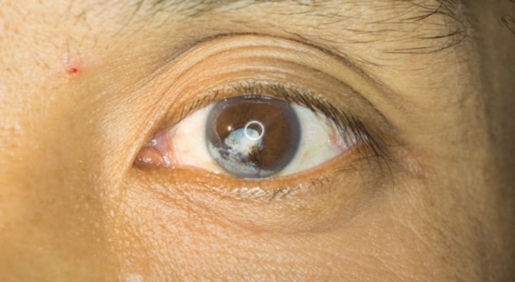 Sẹo giác mạc là kết quả cuối cùng của quá trình tự chữa lành sau khi bị tổn thương sâu