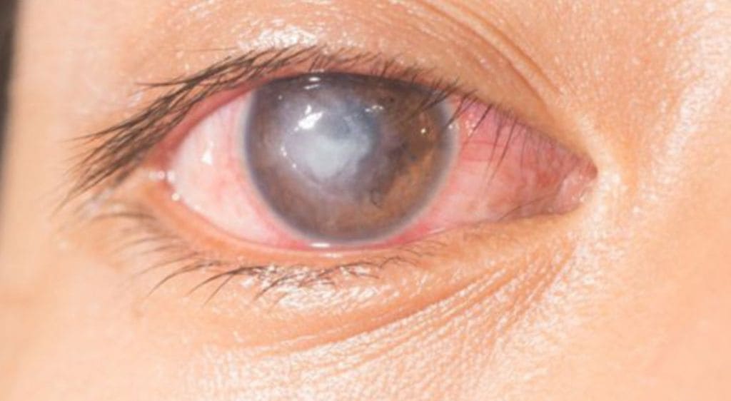 Sẹo giác mạc làm giảm độ trong suốt và ảnh hưởng thị lực