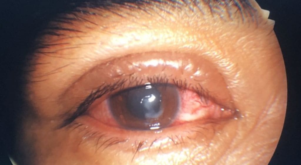 Sẹo sau chấn thương nhẹ có thể được chỉ định PTK