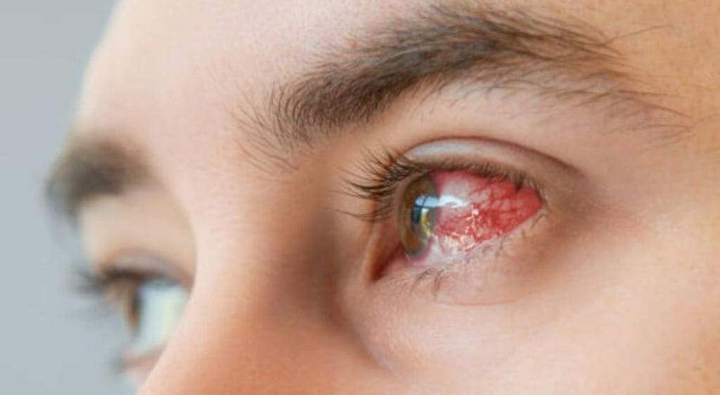 Sử dụng thuốc chứa Corticoid có thể gây viêm loét giác mạc