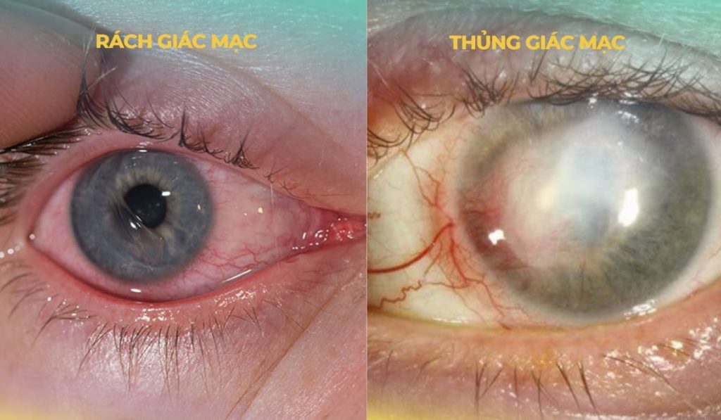 Sự khác nhau giữa rách giác mạc và thủng giác mạc