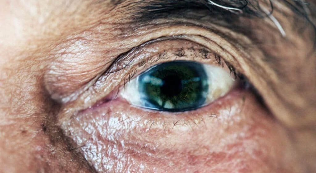 Thoái hóa giác mạc do quá trình lão hóa tự nhiên