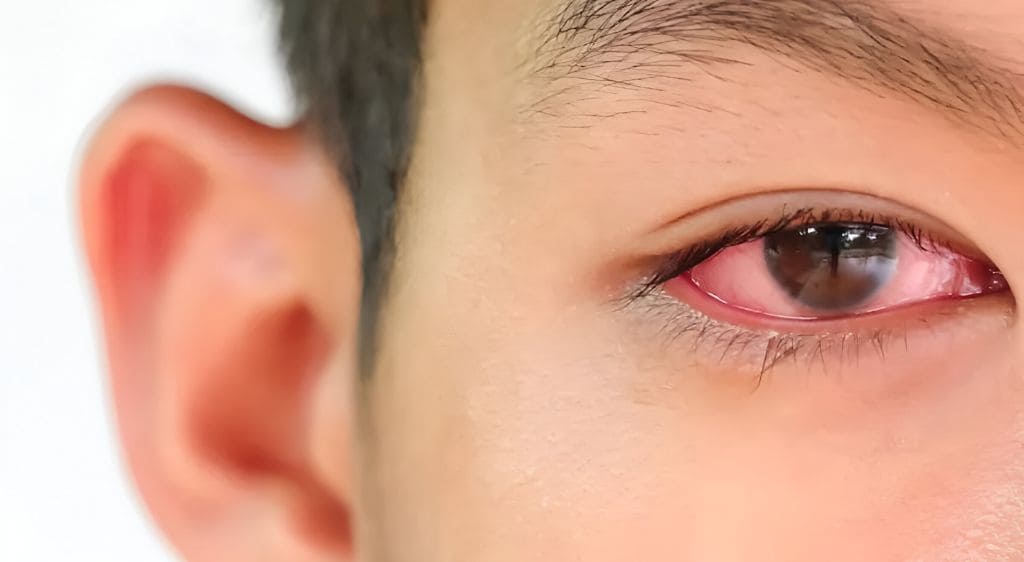 Trầy xước giác mạc gây đỏ mắt, chảy nước mắt