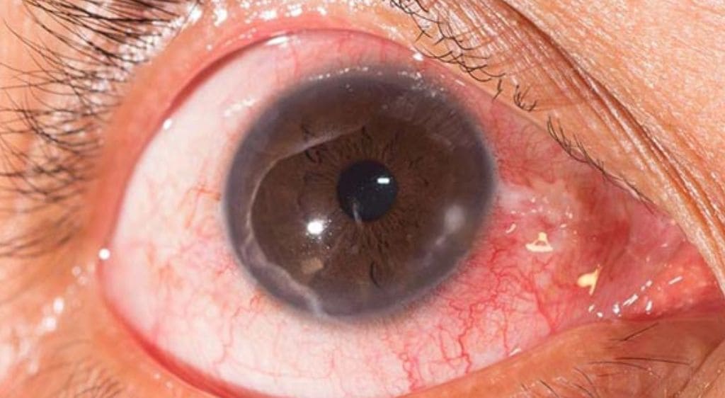 Vệt đục xuất hiện trong mắt là dấu hiệu nhận biết sẹo và đục giác mạc