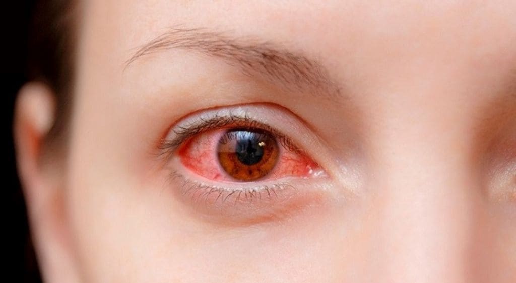 Viêm giác kết mạc là tình trạng viêm đồng thời cả lớp lòng trắng và lòng đen của mắt