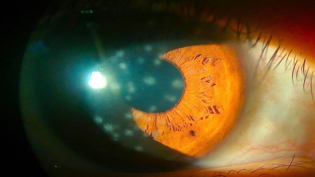 Viêm giác mạc chấm nông là các tổn thương giống chấm nhỉ li ti trên bề mặt giác mạc