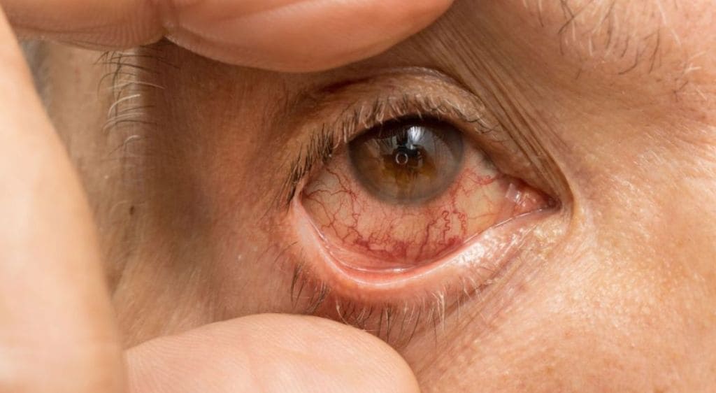 Viêm giác mạc xuất hiện các vết loét gây cản trở tầm nhìn